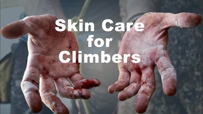 How to Take Care for Flappers in Climbing? Prevention and Skin Care ( 2024 Guide )